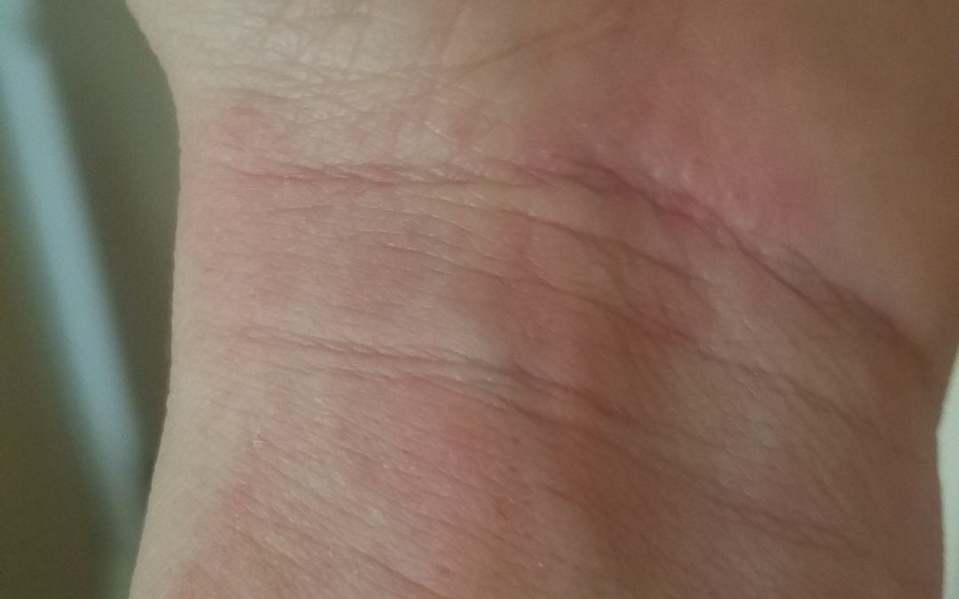 Battling Eczema What To Do To Solve The Burn And Itch